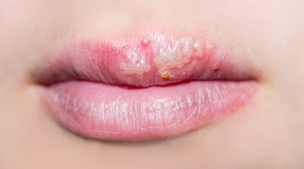 Herpes on Gums Pictures – 8 Photos & Images / illnessee.com