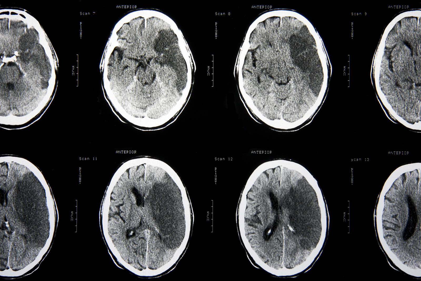 Diagnosis Of Ischemic Stroke Net Health Book