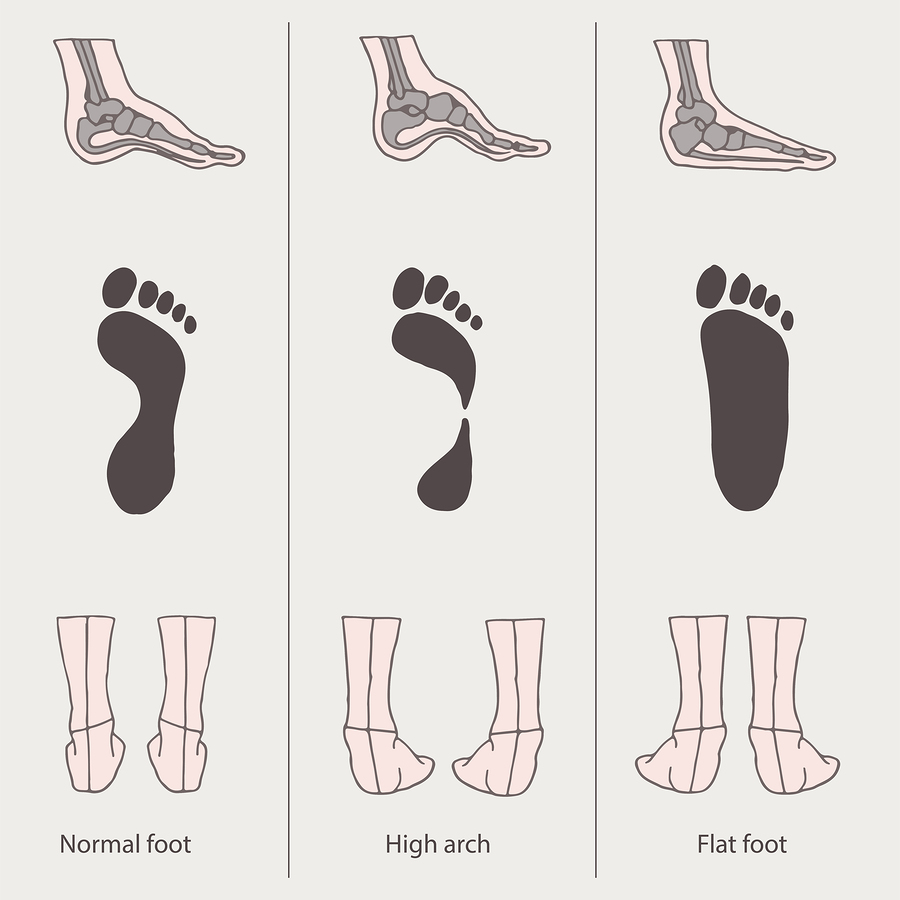one flat foot