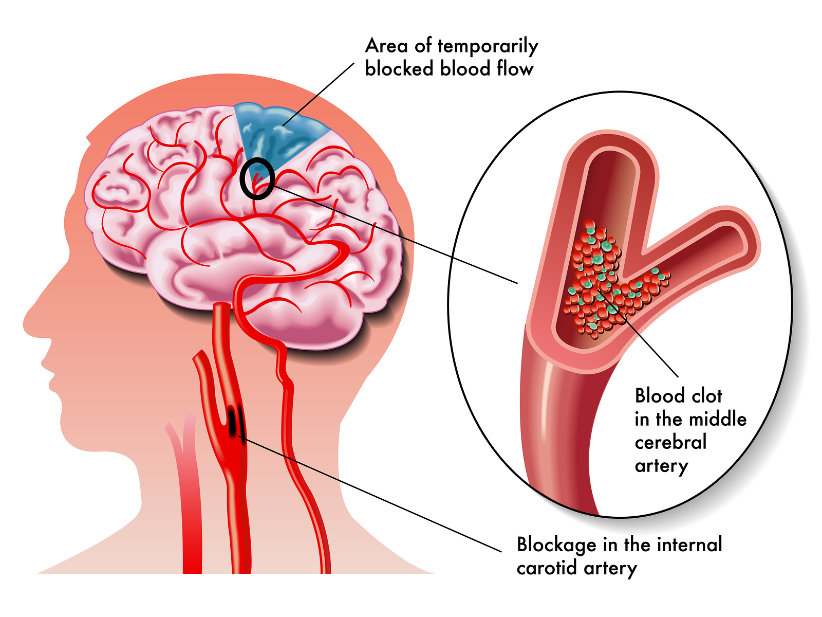 Transient Ischemic Attack Net Health Book