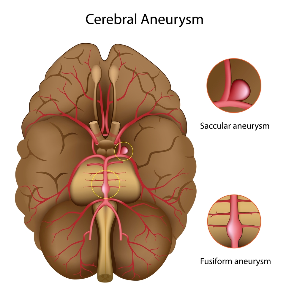 Brain Aneurysm - Net Health Book
