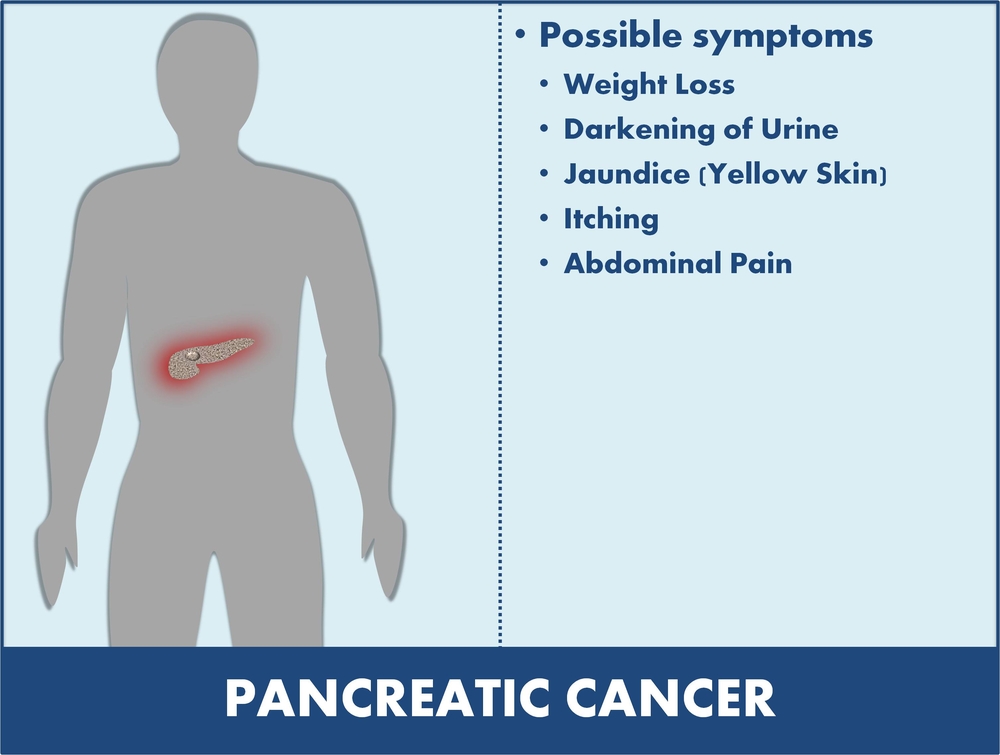 Symptoms Of Cancer Of The Pancreas Net Health Book
