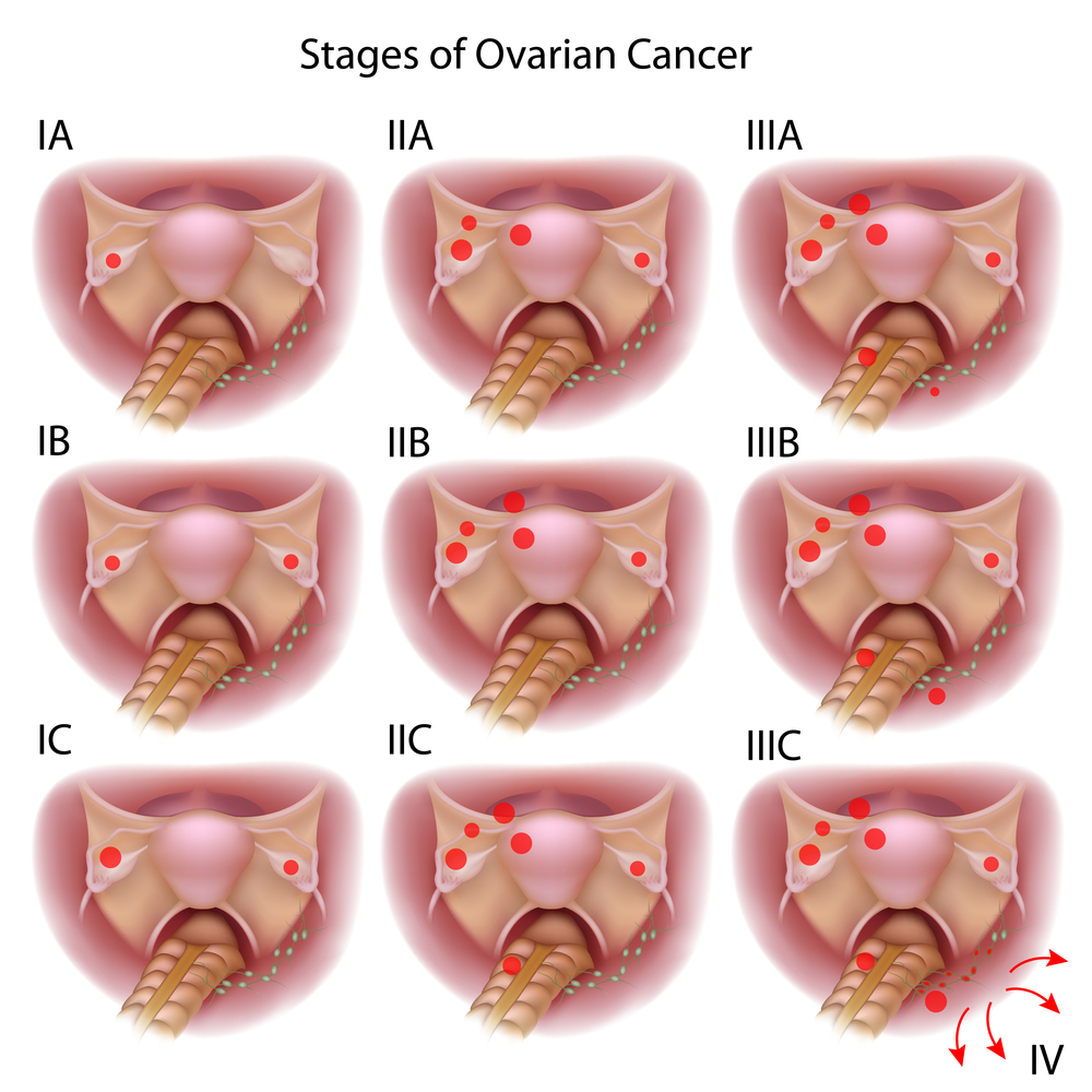 ovarian cancer stages
