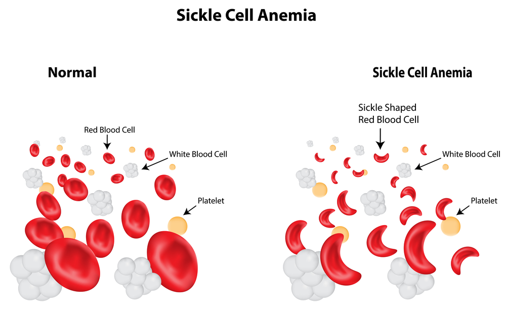 sickle cell anemia quincy me