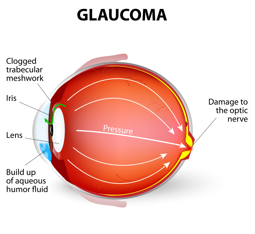 Optic Atrophy Net Health Book