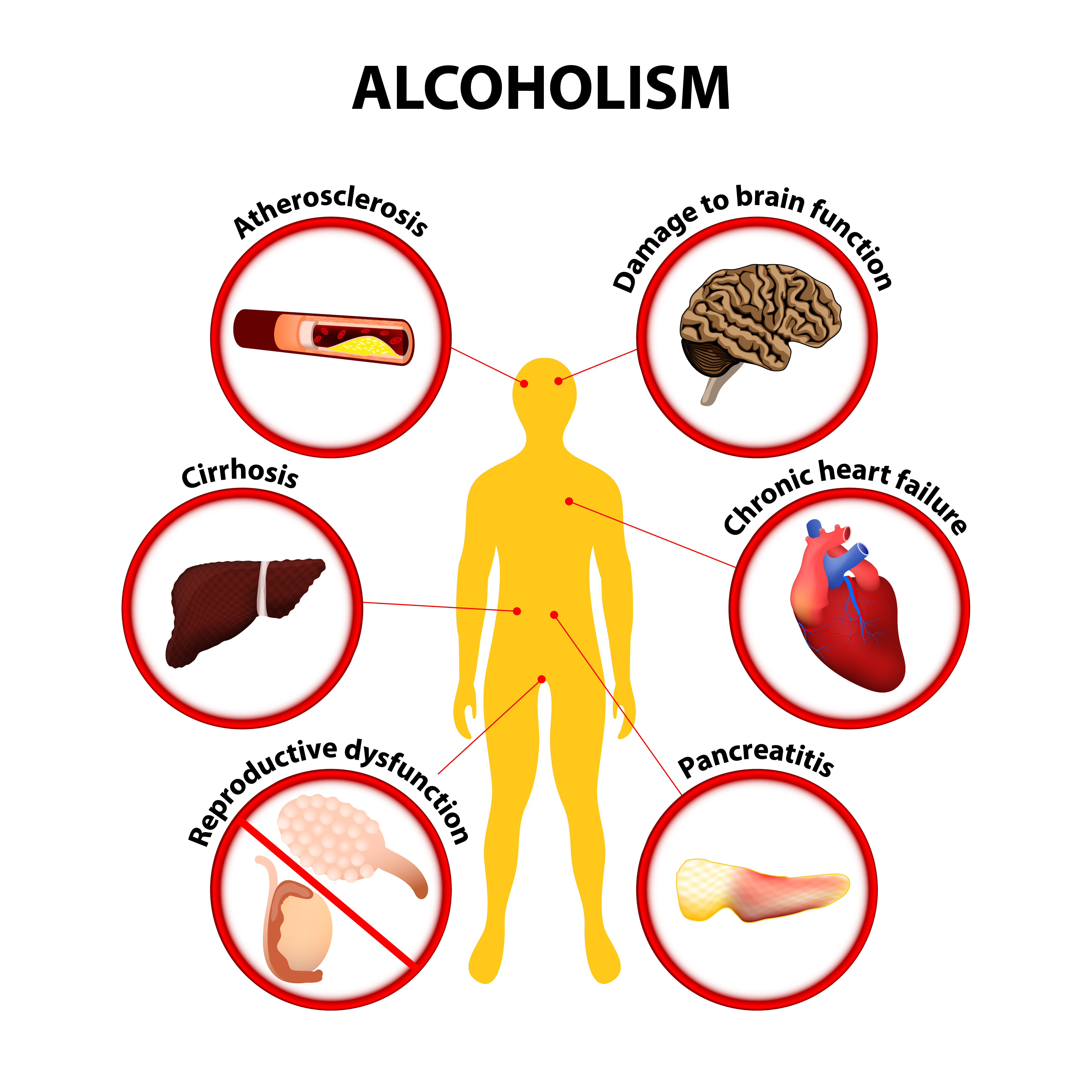 Acute Pancreatitis (Alcohol Is One Of The Causes) Net Health Book