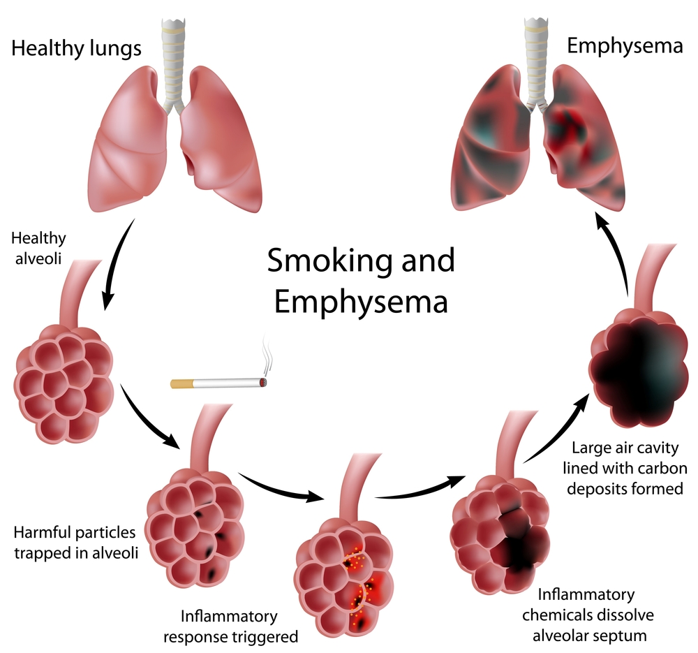 Emphysema Net Health Book