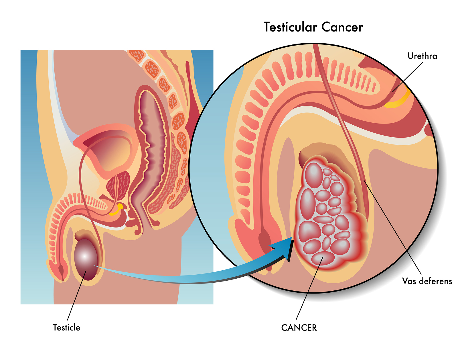 Germ Cell Tumors And Testicular Cancer Net Health Book