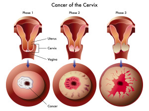  Cervical Cancer