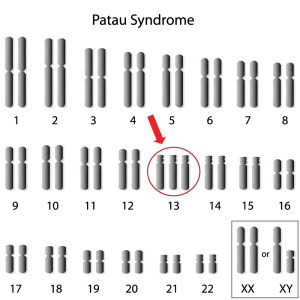 Trisomy 13 (Patau) Syndrome