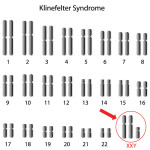 Klinefelter syndrome - Net Health Book