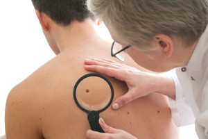 Moles and skin cancer