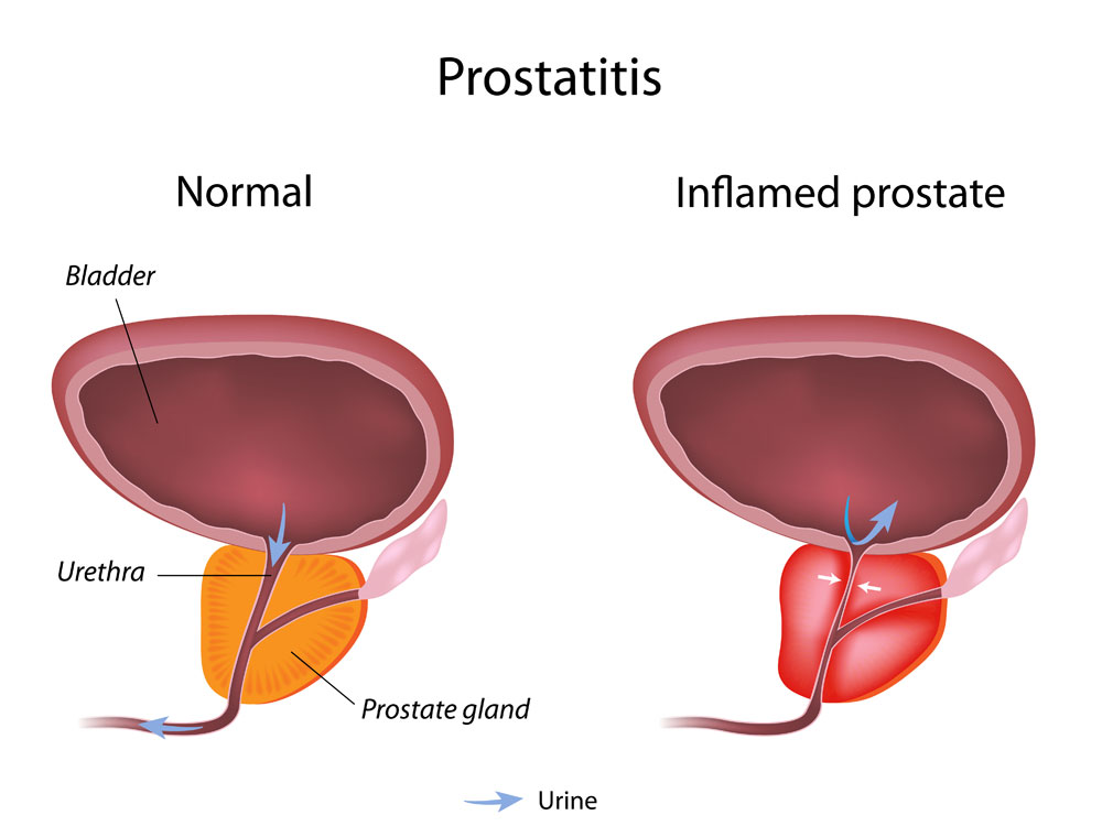 What is prostate problem