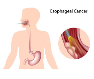 Endoscopy is used to diagnose esophageal cancer
