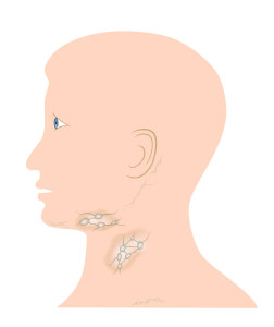 Common lymph glands affected by Hodgkin's disease