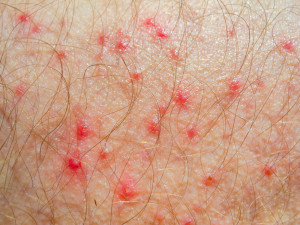 Folliculitis is an infection involving the hair follicle