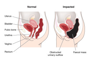 Impaction, The End Stage Of Chronic Constipation