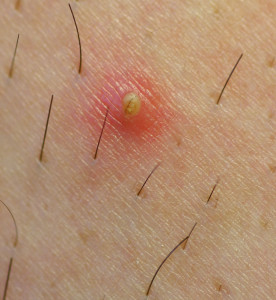 Infection of hair follicle
