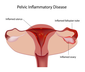 Pelvic inflammatory disease (PID)