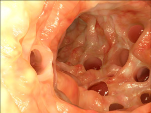 Diverticular disease (colonoscopy)