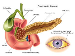 Pancreatic Cancer Linked To Diabetes