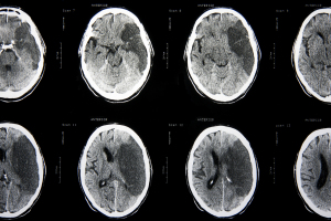  Diagnosis Of Ischemic Stroke (CT Scan Of Brain)