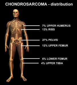  Chondrosarcoma
