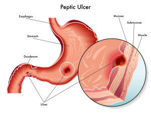  Ulcers