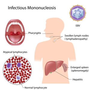 Infectious Mononucleosis