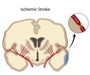  Ischemic Stroke