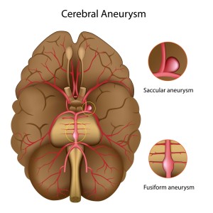  Brain Aneurysm