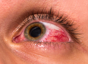  Symptoms Of Eye Disease (Glaucoma Patient)