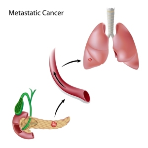  Pancreatic Cancer Staging