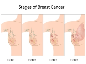  Appropriate Staging Of Cancer