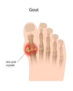  Treatment Of Gout