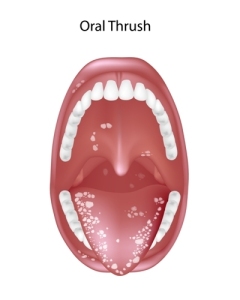  Oral Candidiasis