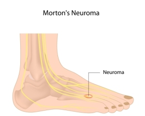  Morton’s Neuroma