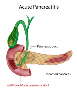  Pancreatitis