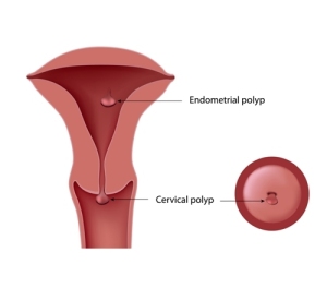  Causes Of Cervical Cancer