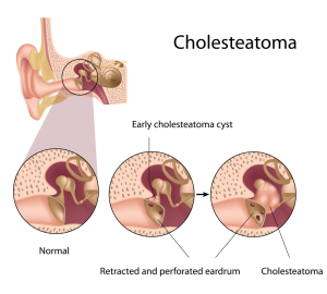 Deafness (Cholesteatoma Can Cause It)