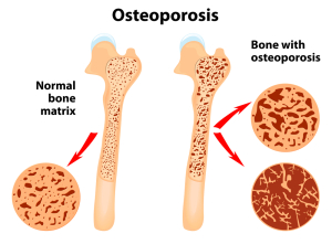  Diagnostic Tests For Osteoporosis