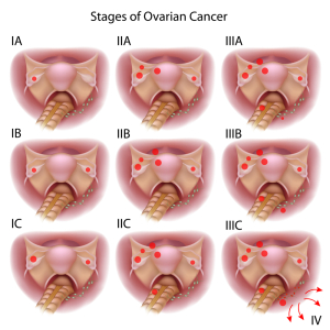  Staging Of Ovarian Cancer