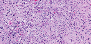  Histoplasmosis (Biopsy Shows Granulomatous Reaction With Intracellular Fungus)