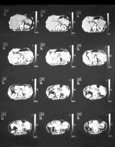  Hereditary Elliptocytosis And Spherocytosis (CT Scan With Huge Splenomegaly)