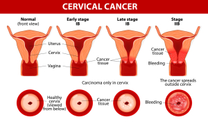  Staging Of Cervical Cancer