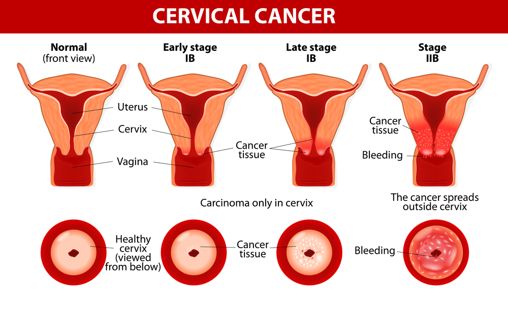 Staging Of Cervical Cancer Net Health Book