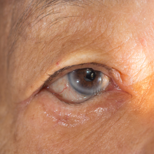 Eyelid Problems (Entropion Of LowerEye Lid)