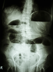 Staging Of Stomach Cancer