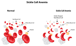  Sickle Cell Anemia