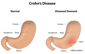  Treatment For Crohn’s Disease